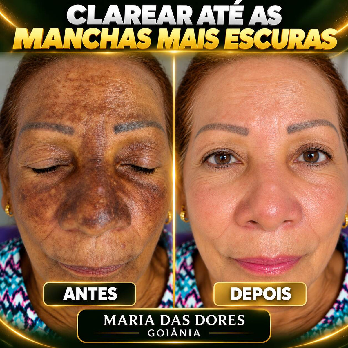 VERON™ Kojic Flash Extreme